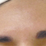 MM_Después 4 semanas