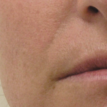 PNL_después 5 semanas